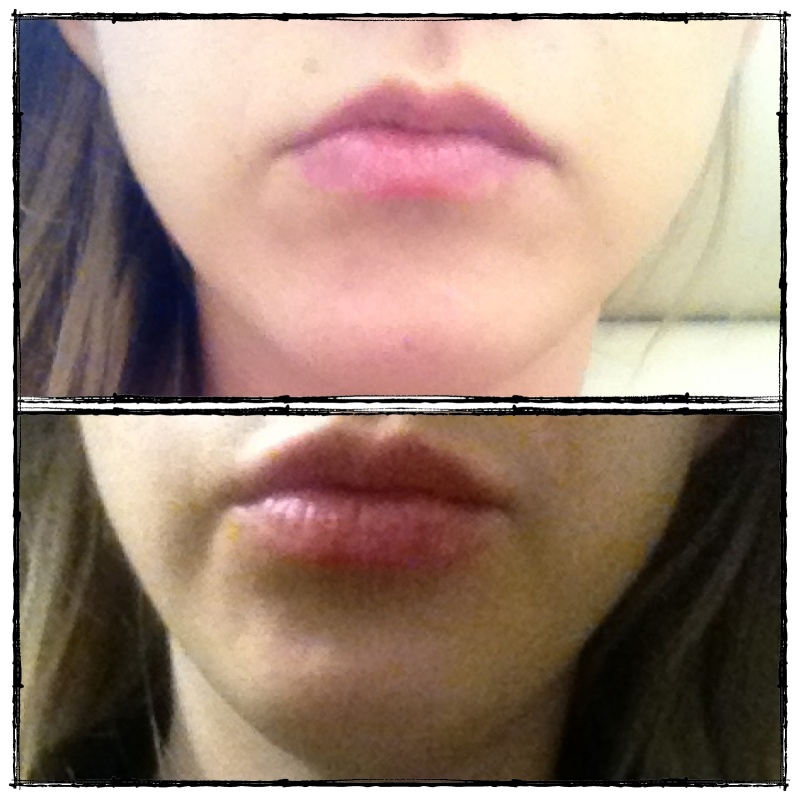 Удаление малых губ до и после фото. Исправление асимметрии губ. Увеличение верхней губы. Асимметрия верхней губы. Небольшая ассиметрия губ.