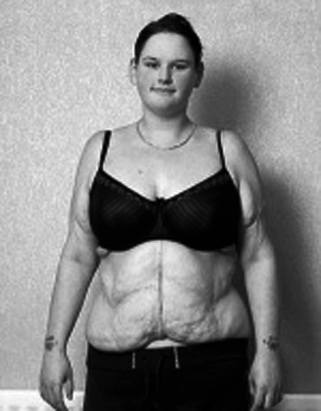 Мягкий живот пожилой крупным планом. Липодистрофия целлюлит. Толстое тело женщины. Кожа после бариатрии фото. Обвисание живота у женщин.